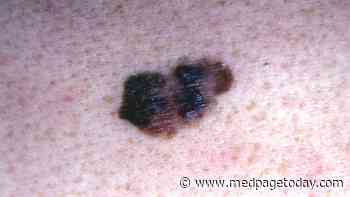 TKI Plus Immunotherapy Active in Melanoma After Anti-PD-1 Progression