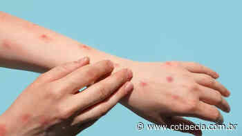 Estado confirma mais um caso de varíola dos macacos em Cotia e total vai a 3 infectados - Cotia e Cia