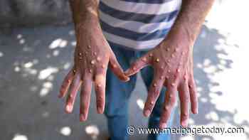 How Monkeypox Can Present Like Common STIs