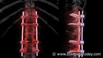 Does Spinal Fusion Reduce Revision Surgeries in Lumbar Spinal Stenosis?
