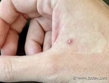 How contagious is monkeypox? How to know if you're at risk