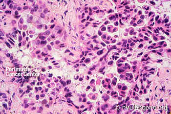 Perlmutter Cancer Center Medical Oncologist Conducts Clinical Trial of Targeted Therapy for Advanced EGFR-Mutant Lung Cancer - NYU Langone Health