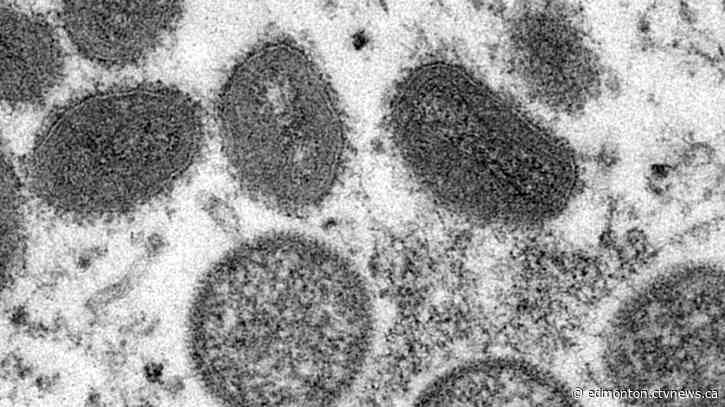 Alberta to offer vaccine to gay, bisexual, queer men at 'higher risk' of monkeypox exposure