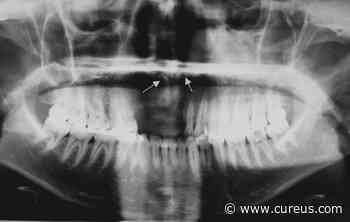 Bilateral Inverted Mesiodens: A Rare Case Evaluated by Cone-Beam Computed Tomography - Cureus