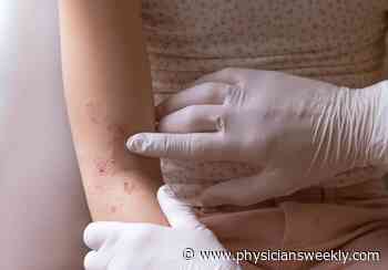 Pityriasis Rosea & Coronavirus Disease: Immunological Connection - Physician's Weekly