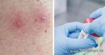 Bayreuth: Erster Affenpocken-Fall in der Region aufgetreten - Infizierter (35) in Isolation - inFranken.de