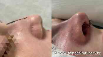 Plástica no nariz sem martelo: conheça a rinoplastia ultrassônica - Folha de Irati