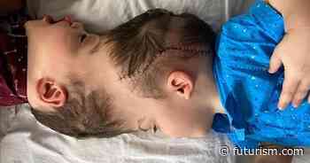 Surgeons Use VR Headsets to Separate Conjoined Twins - Futurism