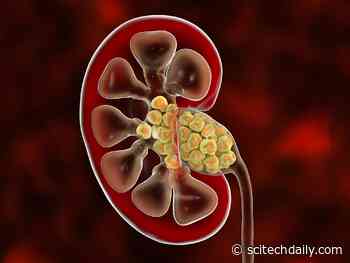 Mayo Clinic Study Uncovers Dietary Trick To Help Prevent Kidney Stones