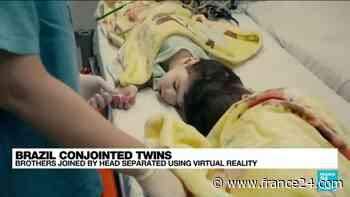 Brazil: Conjoined twins separated with help of virtual reality - France 24 - FRANCE 24 English