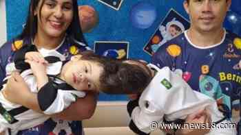 Cojoined Twins in Brazil Seperated Using Virtual Reality After Marathon 27-hour Surgery - News18