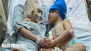 Conjoined twins separated with the help of virtual reality