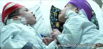 Gêmeos unidos pelo crânio são separados após nove cirurgias - Folha de Irati