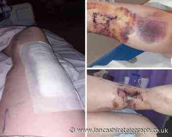 Graphic images: Blackburn woman calls for law change after dog attack