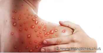 Monkeypox: Health Secretary urged to take more action on disease - Ealing Times