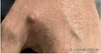 Brusque confirma primeiro caso de varíola dos macacos na cidade - ND Mais
