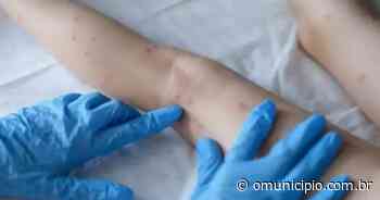 Brusque confirma primeiro caso de varíola dos macacos - O Município