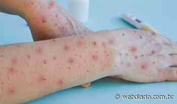 Itapevi registra 10° caso de varíola do macaco e Osasco o 8° - webdiario.com.br