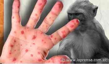Suben a 5 los casos de viruela del mono - Diario La Prensa Riobamba