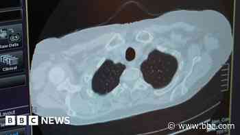 Cornwall lung screening pilot aims to diagnose cancer sooner - bbc.com