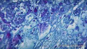 Seven confirmed cases of Monkeypox in Monroe County according to CDC