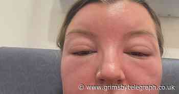 Festival-goer left 'looking like sloth from Goonies' after 'sun poisoning' - Grimsby Live