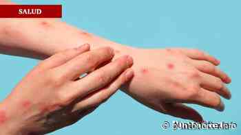 Confirman 3 casos de viruela del mono en Tijuana, Mexicali y Ensenada - Punto Norte