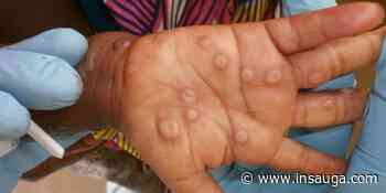 Nine cases of Monkeypox reported in Burlington, Oakville, Milton since May | inHalton - insauga.com