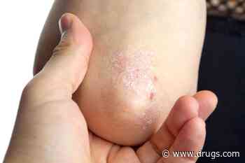 Causal Link Suggested for Psoriasis, Cardiovascular Disease