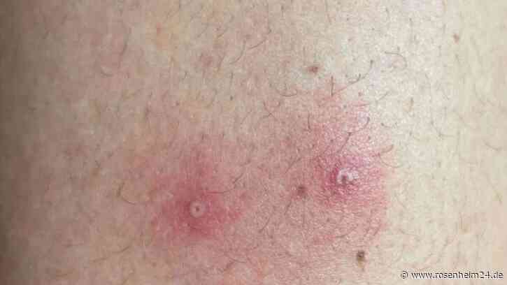 Erster Affenpocken-Fall in der Region: Indexperson ist männlich und hat sich im „nahem Ausland angesteckt“