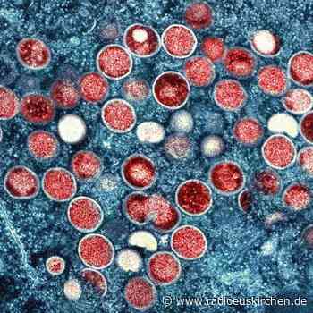 Affenpocken-Fälle in Europa steigen - radioeuskirchen.de