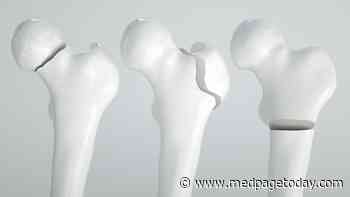 More Hip Fractures Seen in Women With This Diet