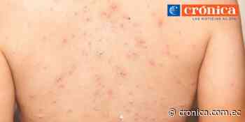 Ante caso de viruela del mono en Loja: Profesionales recomienda guardar calma y precaución - Diario Crónica (Ecuador)