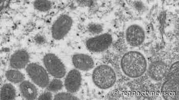 SHA alerts public about elevated risk of Monkeypox