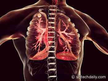 Worse Than Smoking – Bad Sleep Can Worsen Lung Disease
