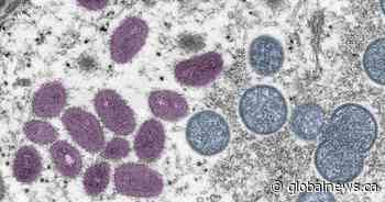 What you need to know about monkeypox in Saskatchewan