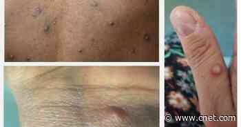 Monkeypox Cases Up Nearly 60%: Here Are the Symptoms You Need to Look Out For     - CNET