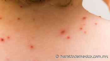 Viruela del Mono en Morelos: Reporta 2 casos del virus en Cuernavaca - El Heraldo de México