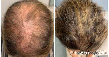 An Old Medicine Remedies Hair Loss for Pennies a Day, Doctors Say - The New York Times