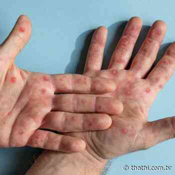 Ilha Solteira registra o seu primeiro caso de varíola dos macacos - Portal Thathi