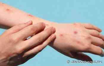 Descartan caso de viruela del mono en Hermosillo - Diario del Yaqui