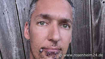 Erotikstar Silver Steele spricht über seine schmerzhafte Affenpocken-Infektion