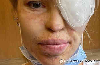 Katie Piper back on TV days after agonising hospital dash for emergency eye operation - Yahoo News UK