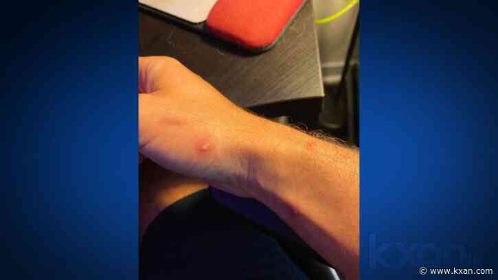 Medical worker to take short-term disability to recover from monkeypox