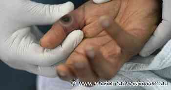 UK to pilot smaller doses of monkeypox jab - Western Advocate