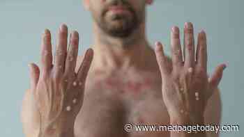The Classification of Monkeypox Should Include Its STI Status