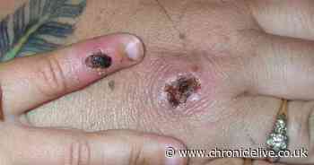 British scientists become first in world to launch trial for treatment of monkeypox