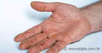Vigilância em Saúde de Brusque explica sobre lesões causadas pela varíola dos macacos - O Município