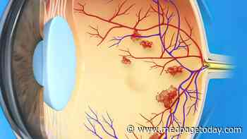Step Therapy Succeeds for Diabetic Macular Edema