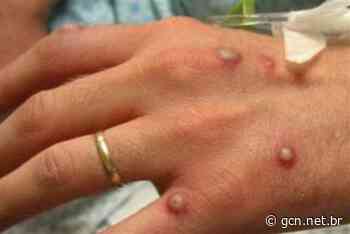 Batatais registra dois casos suspeitos de varíola dos macacos - Portal GCN